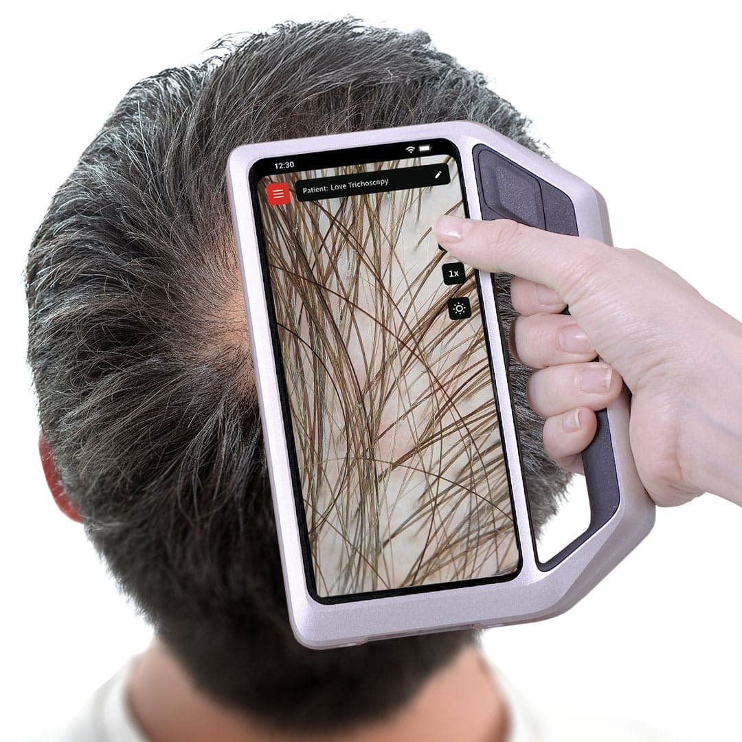 Examen trichoscopique du cuir chevelu avec le dispositif skeen de FotoFinder